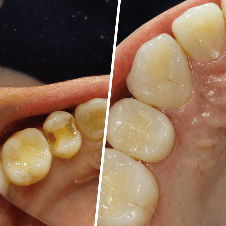 Paciente de Restauración